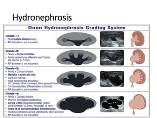 Hydronephrosis