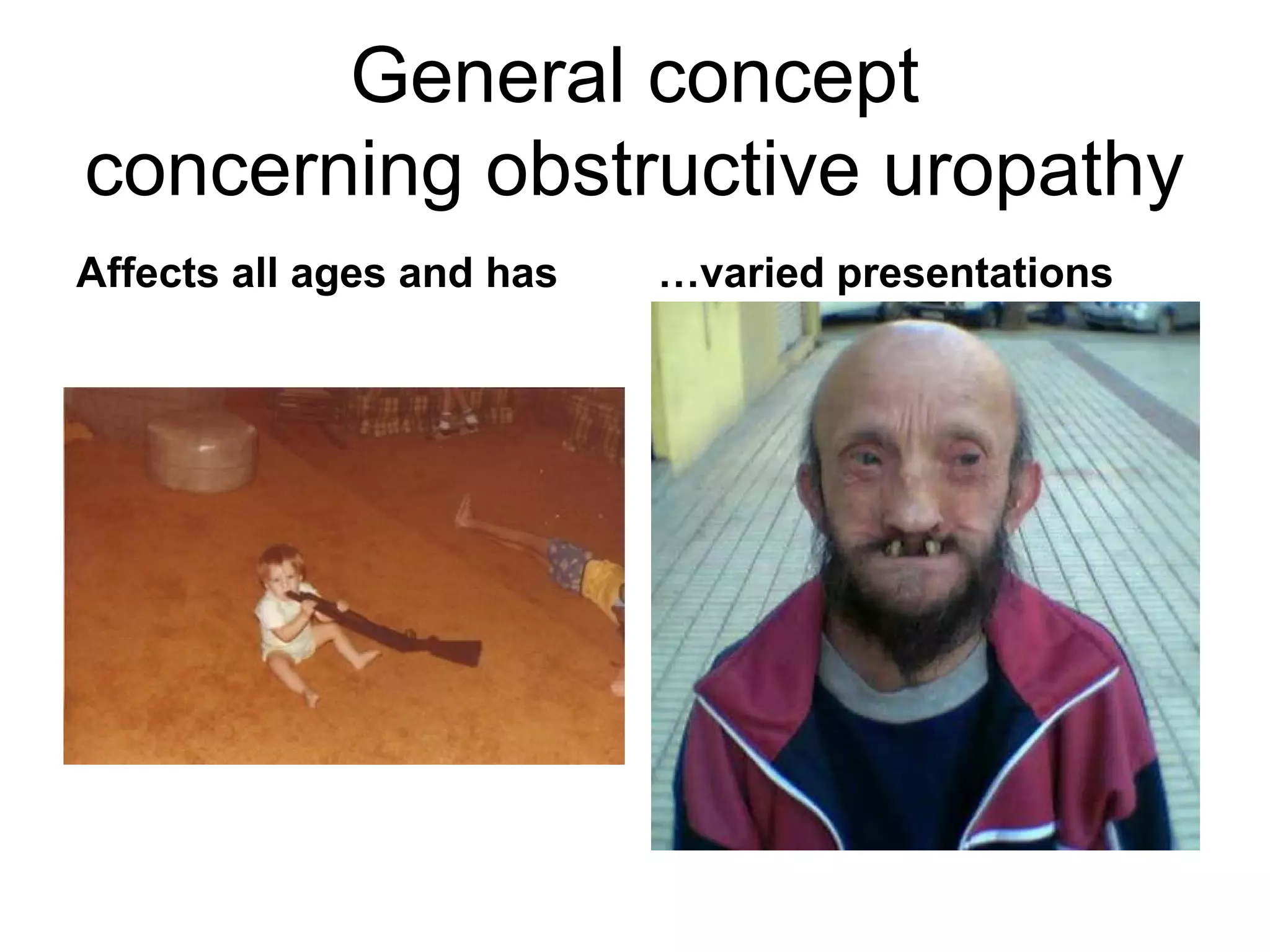 General concept
concerning obstructive uropathy
Affects all ages and has …varied presentations
 