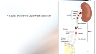 • Causes of unilateral upper tract obstruction
47
 