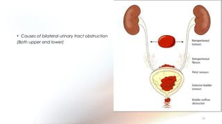 • Causes of bilateral urinary tract obstruction
(Both upper and lower)
50
 