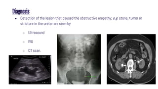 Diagnosis
● Detection of the lesion that caused the obstructive uropathy; e.g. stone, tumor or
stricture in the ureter are seen by
○ Ultrasound
○ IVU
○ CT scan.
 