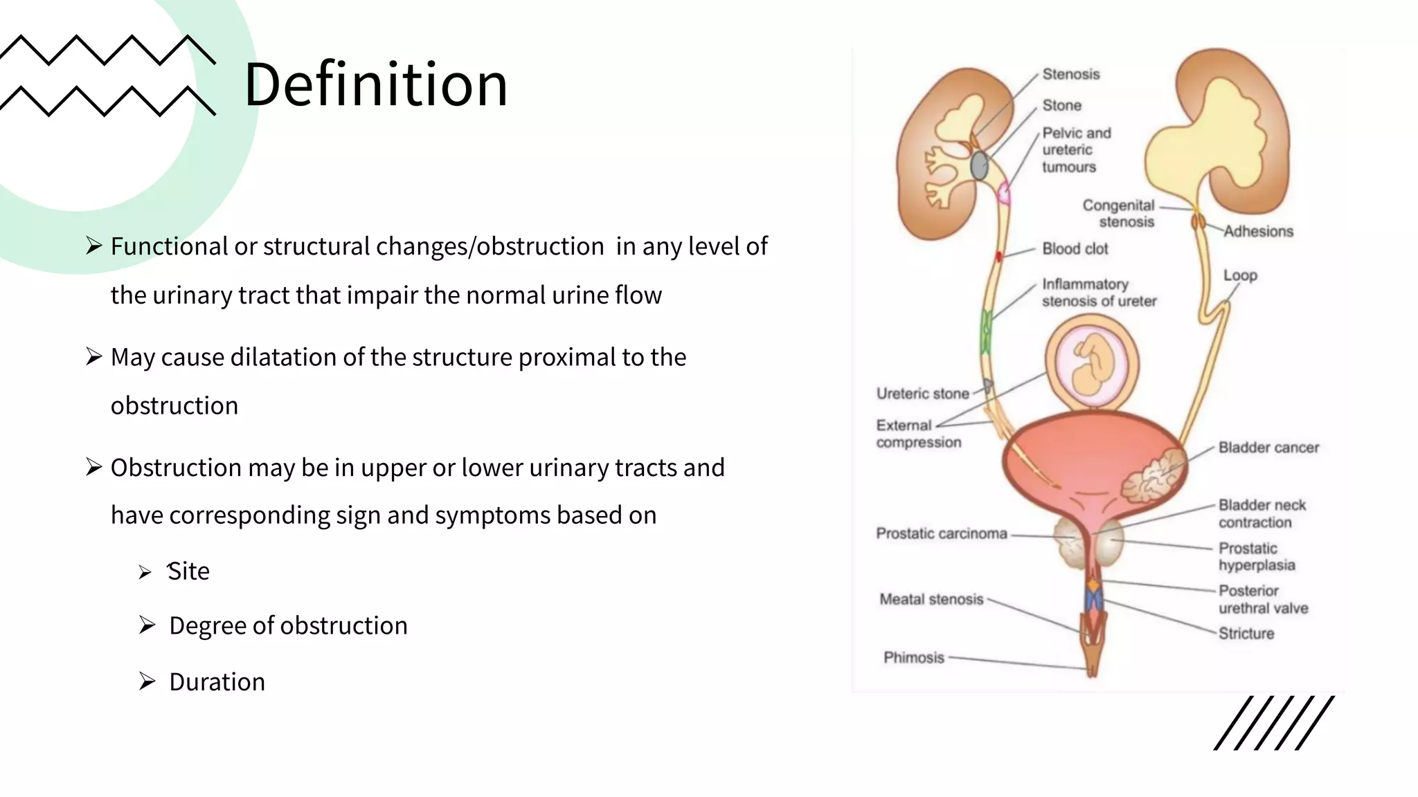 Definition
Ø Functional or structural changes/obstruction in any level of
the urinary tract that impair the normal urine flow
Ø May cause dilatation of the structure proximal to the
obstruction
Ø Obstruction may be in upper or lower urinary tracts and
have corresponding sign and symptoms based on
Ø ́Site
Ø Degree of obstruction
Ø Duration
 