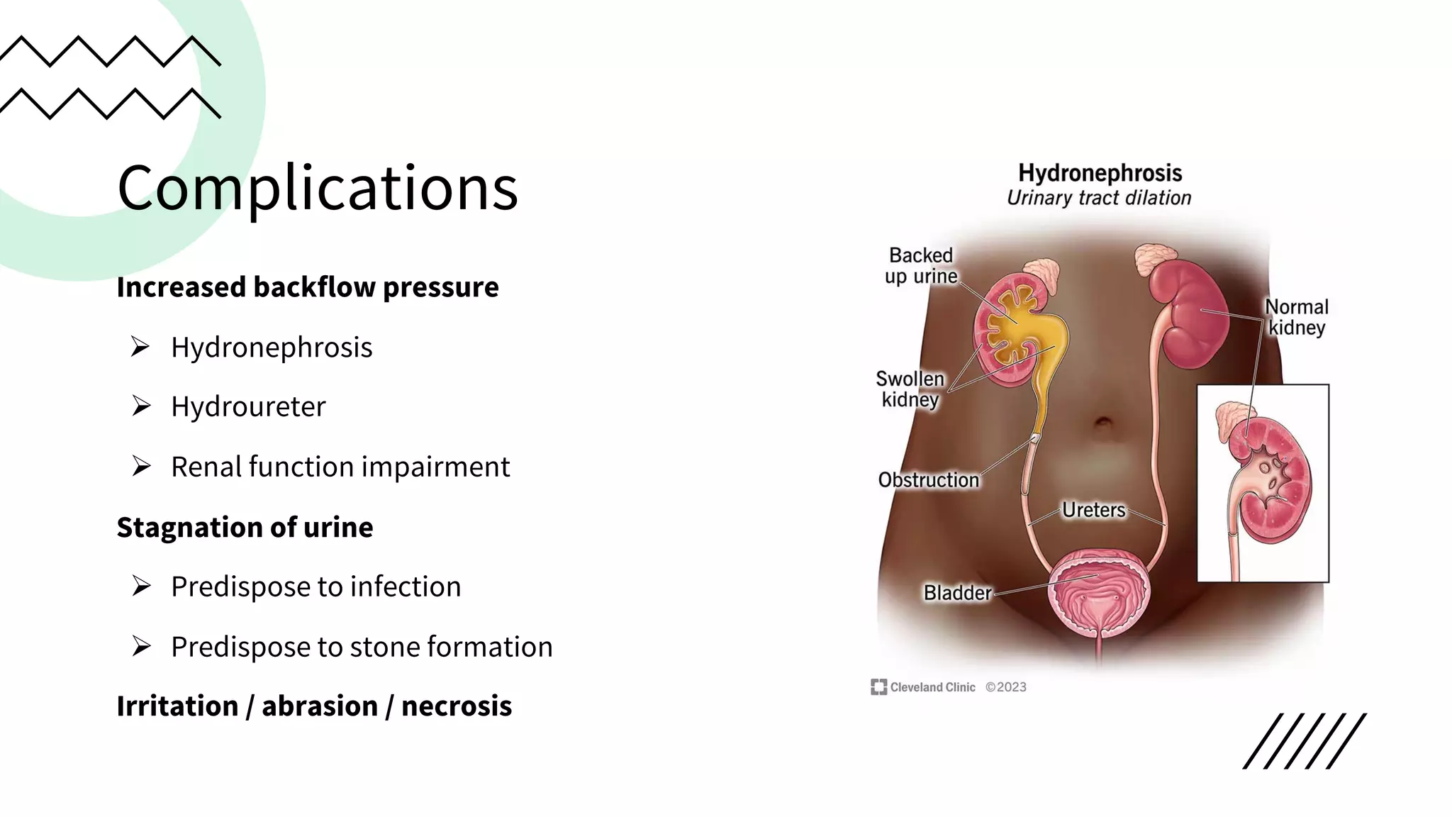 Complications
Increased backflow pressure
Ø Hydronephrosis
Ø Hydroureter
Ø Renal function impairment
Stagnation of urine
Ø Predispose to infection
Ø Predispose to stone formation
Irritation / abrasion / necrosis
 