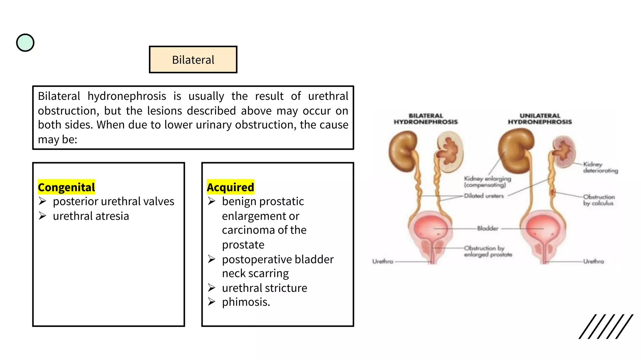 Bilateral
Bilateral hydronephrosis is usually the result of urethral
obstruction, but the lesions described above may occur on
both sides. When due to lower urinary obstruction, the cause
may be:
Congenital
Ø posterior urethral valves
Ø urethral atresia
Acquired
Ø benign prostatic
enlargement or
carcinoma of the
prostate
Ø postoperative bladder
neck scarring
Ø urethral stricture
Ø phimosis.
 