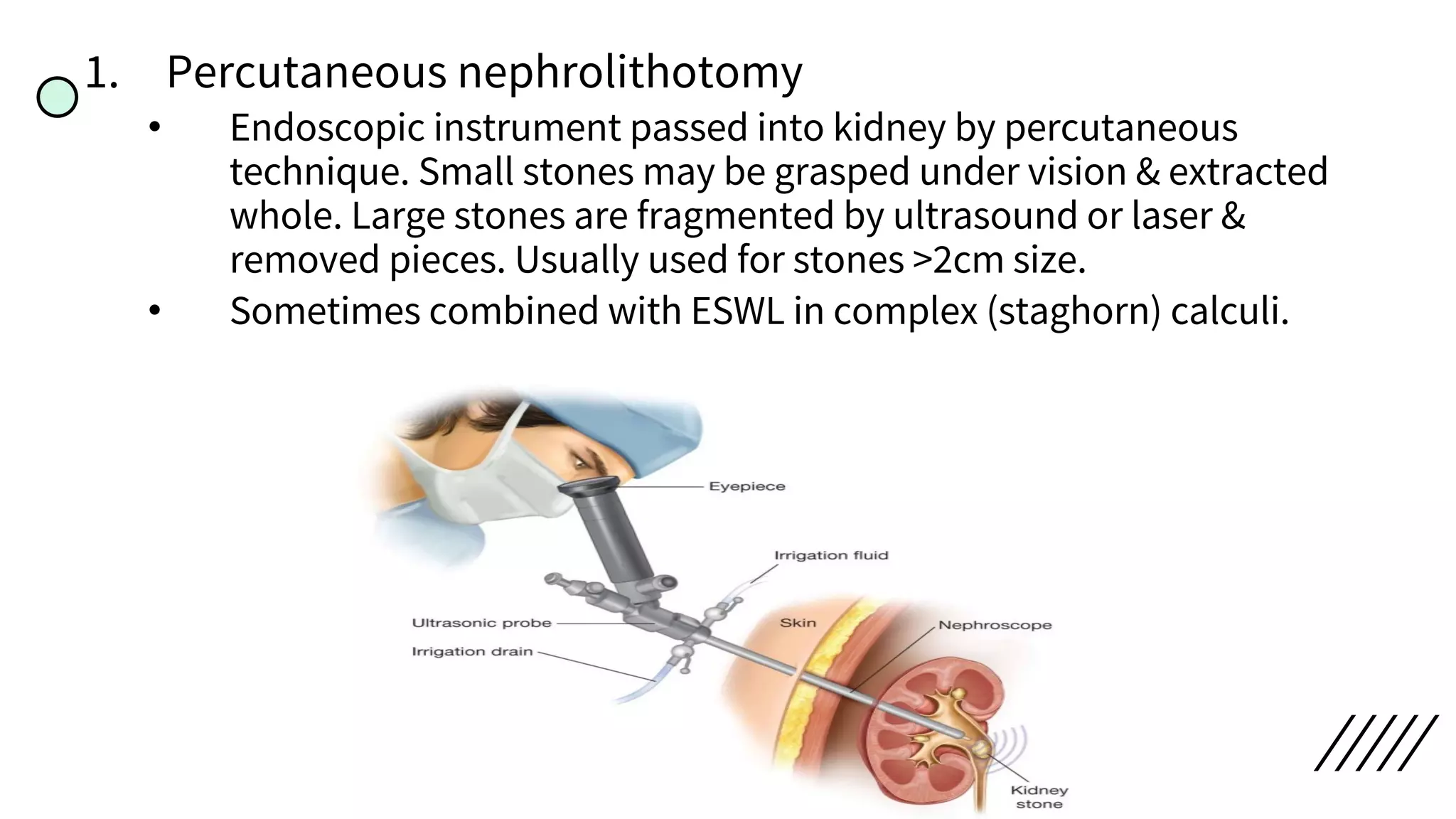1. Percutaneous nephrolithotomy
• Endoscopic instrument passed into kidney by percutaneous
technique. Small stones may be grasped under vision & extracted
whole. Large stones are fragmented by ultrasound or laser &
removed pieces. Usually used for stones >2cm size.
• Sometimes combined with ESWL in complex (staghorn) calculi.
 