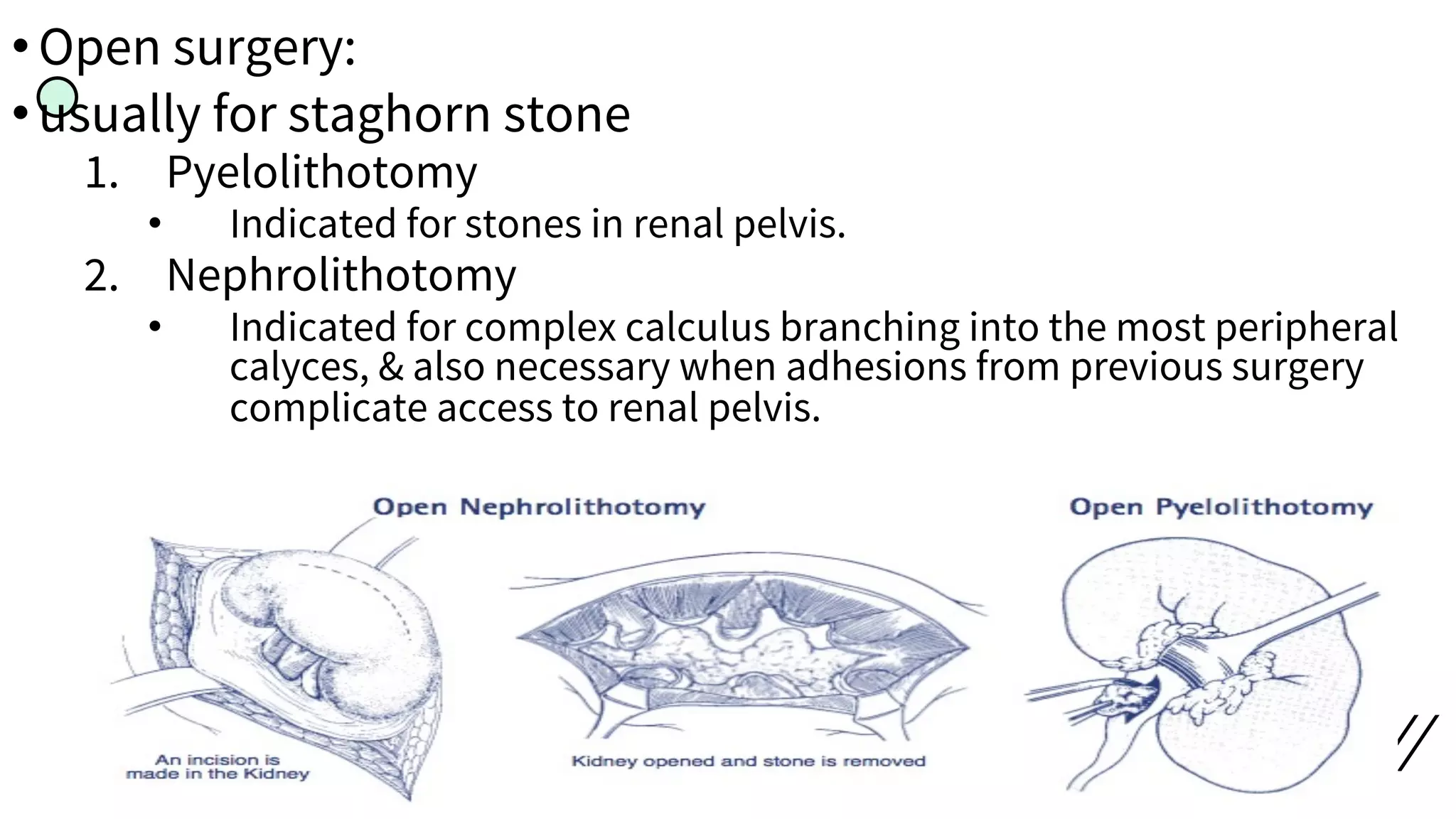 •Open surgery:
•usually for staghorn stone
1. Pyelolithotomy
• Indicated for stones in renal pelvis.
2. Nephrolithotomy
• Indicated for complex calculus branching into the most peripheral
calyces, & also necessary when adhesions from previous surgery
complicate access to renal pelvis.
 