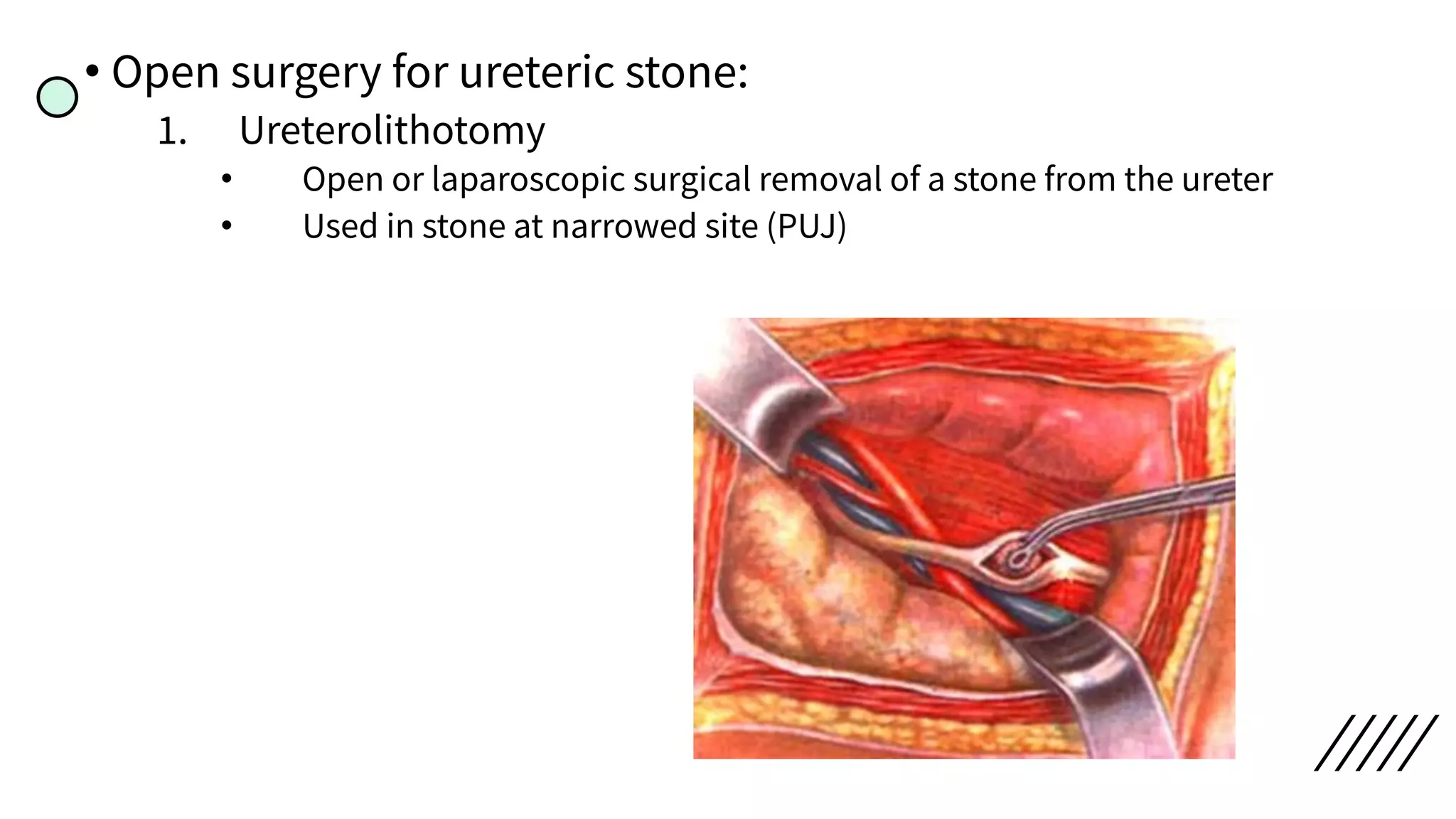 • Open surgery for ureteric stone:
1. Ureterolithotomy
• Open or laparoscopic surgical removal of a stone from the ureter
• Used in stone at narrowed site (PUJ)
 