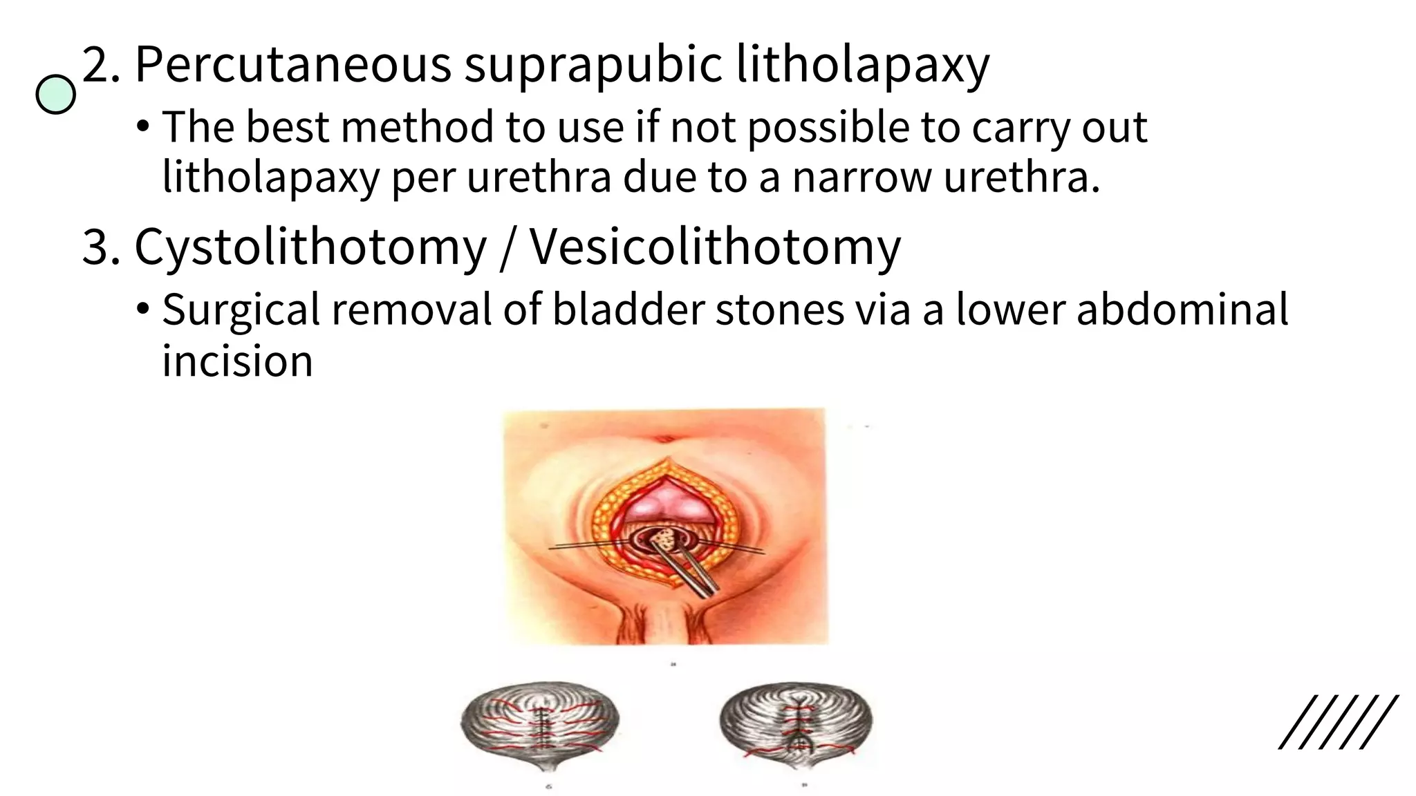 2. Percutaneous suprapubic litholapaxy
• The best method to use if not possible to carry out
litholapaxy per urethra due to a narrow urethra.
3. Cystolithotomy / Vesicolithotomy
• Surgical removal of bladder stones via a lower abdominal
incision
 