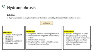 Hydronephrosis
Definition
Ø Hydronephrosis is an aseptic dilatation of the kidney caused by obstruction to the outflow of urine
Extramural
Ø Tumour from adjacent
structures
Ø Idiopathic
retroperitoneal fibrosis
Ø Retrocaval ureter
Unilateral
Intramural
Ø Congenital stenosis, narrowing of the PUJ
Ø Ureterocele and congenital small ureteric
orifice
Ø Inflammatory stricture
Ø Neoplasm of the ureter or bladder cancer
involving the ureteric orifice
Intraluminal
Ø Calculus in the pelvis or ureter
Ø Sloughed papilla in papillary
necrosis (especially in diabetics,
analgesic abusers and those
with sickle cell disease) may
obstruct the ureter
 