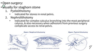 •Open surgery:
•usually for staghorn stone
1. Pyelolithotomy
• Indicated for stones in renal pelvis.
2. Nephrolithotomy
• Indicated for complex calculus branching into the most peripheral
calyces, & also necessary when adhesions from previous surgery
complicate access to renal pelvis.
 