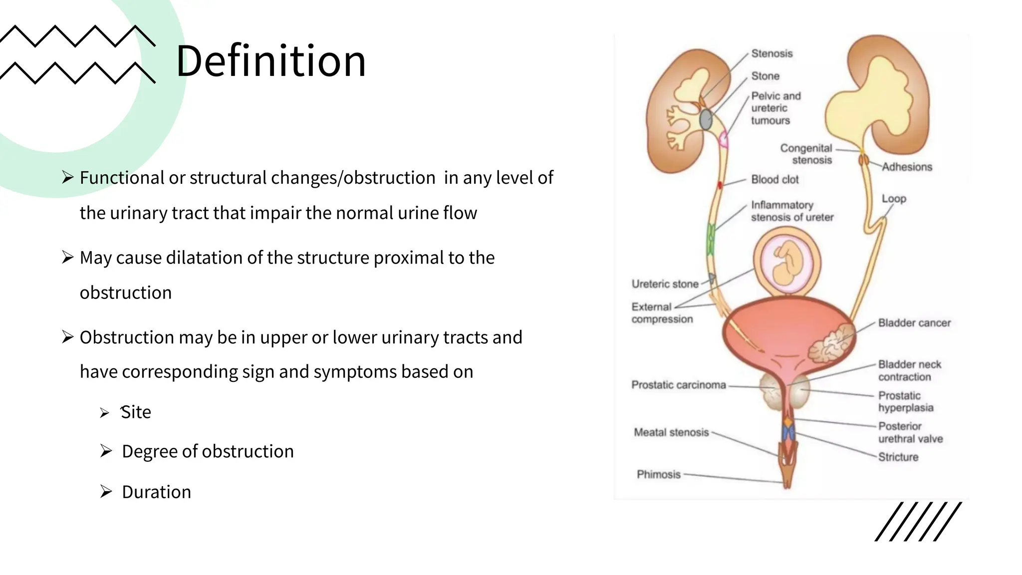 Definition
Ø Functional or structural changes/obstruction in any level of
the urinary tract that impair the normal urine flow
Ø May cause dilatation of the structure proximal to the
obstruction
Ø Obstruction may be in upper or lower urinary tracts and
have corresponding sign and symptoms based on
Ø ́Site
Ø Degree of obstruction
Ø Duration
 