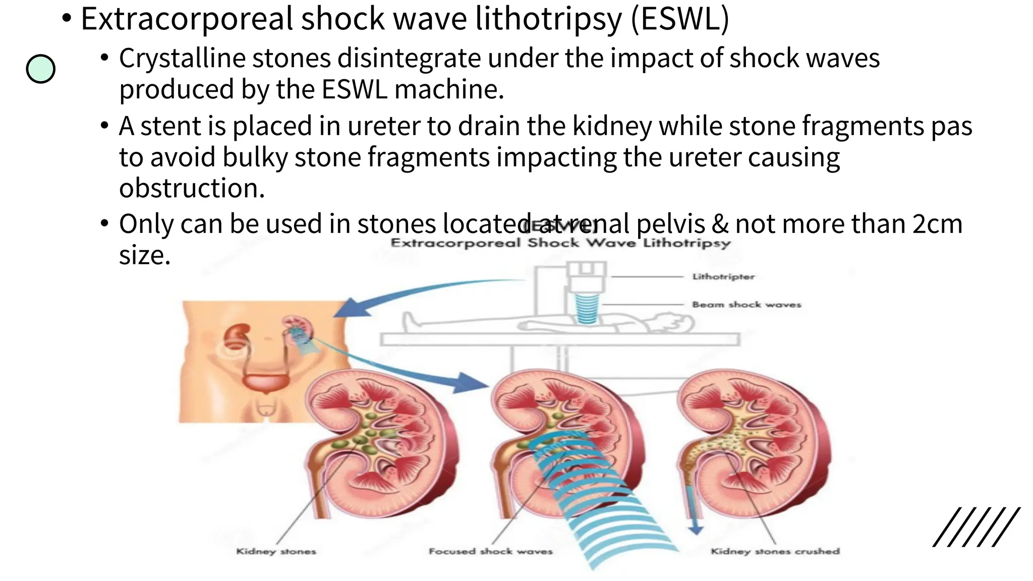 • Extracorporeal shock wave lithotripsy (ESWL)
• Crystalline stones disintegrate under the impact of shock waves
produced by the ESWL machine.
• A stent is placed in ureter to drain the kidney while stone fragments pas
to avoid bulky stone fragments impacting the ureter causing
obstruction.
• Only can be used in stones located at renal pelvis & not more than 2cm
size.
 