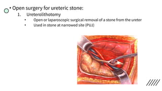 • Open surgery for ureteric stone:
1. Ureterolithotomy
• Open or laparoscopic surgical removal of a stone from the ureter
• Used in stone at narrowed site (PUJ)
 
