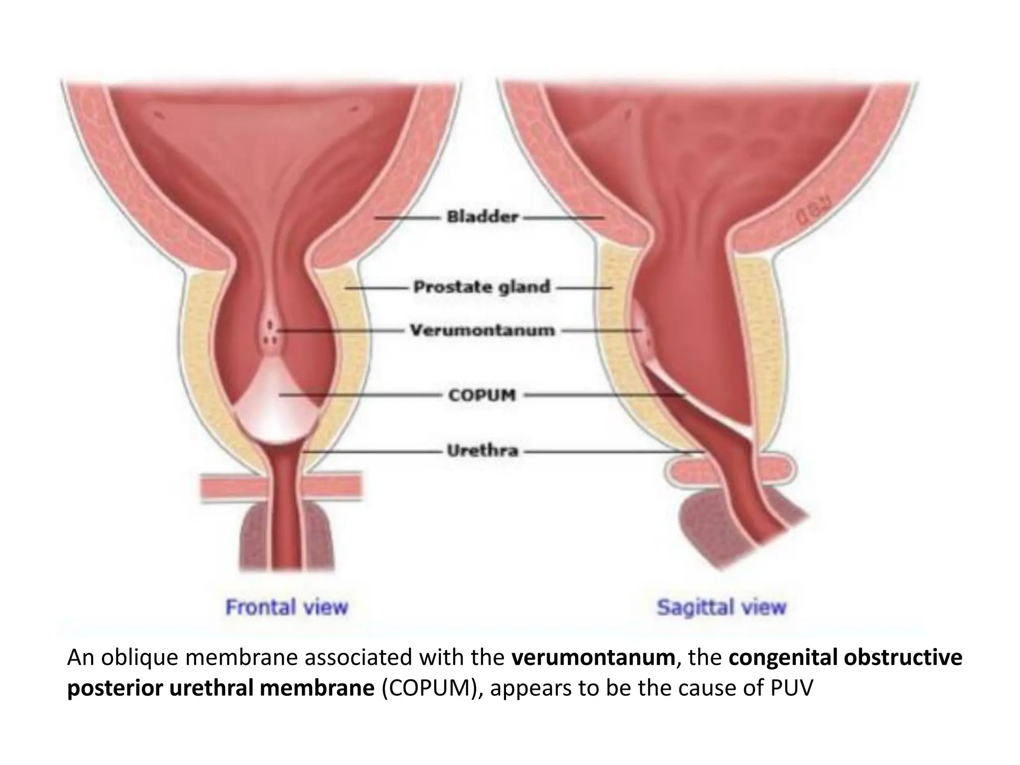 .
• .
An oblique membrane associated with the verumontanum, the congenital obstructive
posterior urethral membrane (COPUM), appears to be the cause of PUV
 