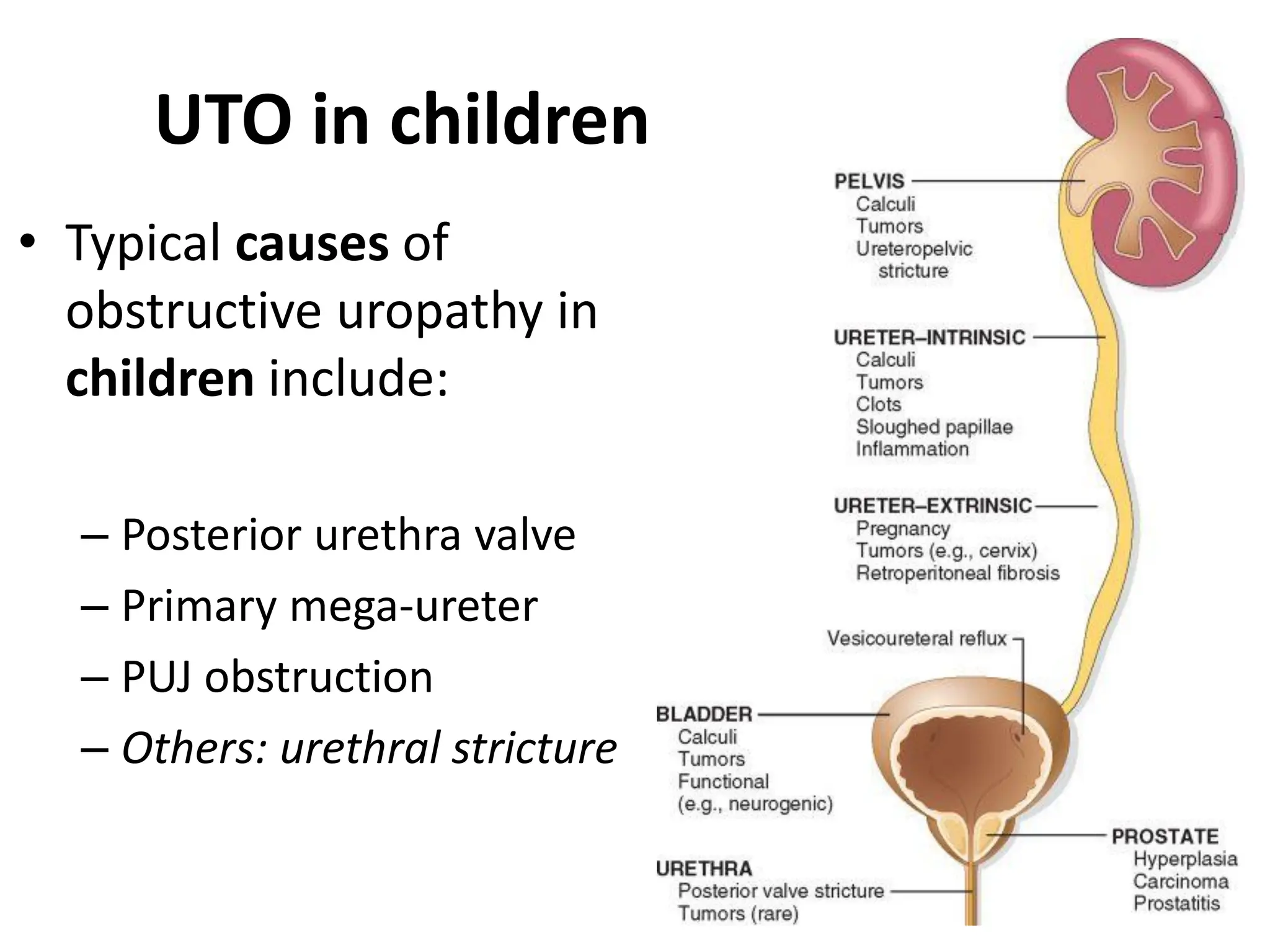 UTO in children
• Typical causes of
obstructive uropathy in
children include:
– Posterior urethra valve
– Primary mega-ureter
– PUJ obstruction
– Others: urethral stricture
 