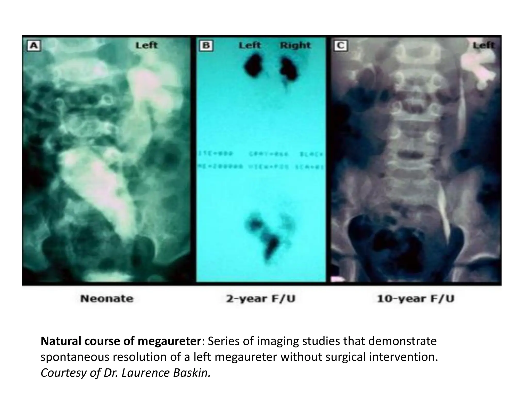 .
• .
Natural course of megaureter: Series of imaging studies that demonstrate
spontaneous resolution of a left megaureter without surgical intervention.
Courtesy of Dr. Laurence Baskin.
 
