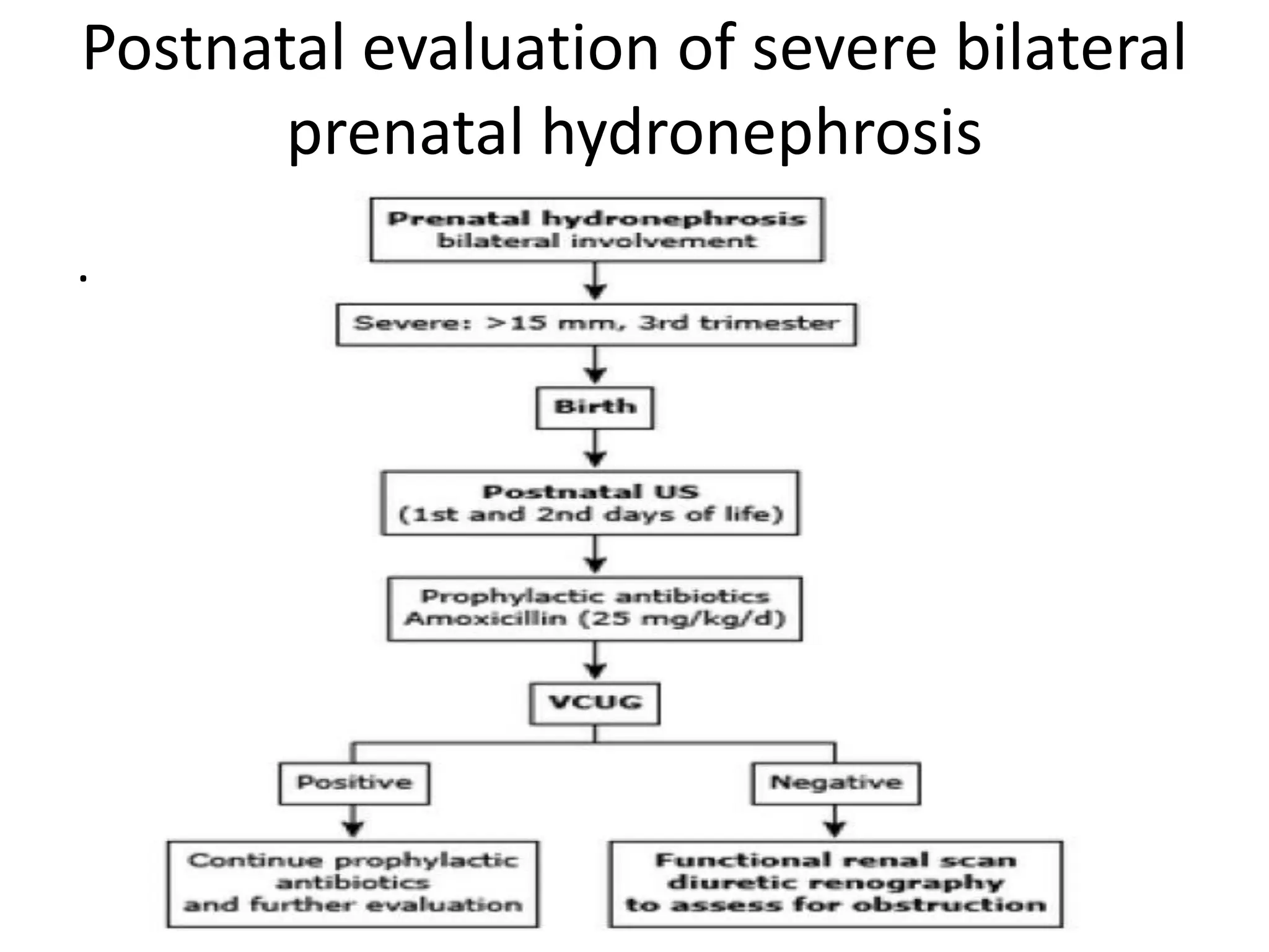 Postnatal evaluation of severe bilateral
prenatal hydronephrosis
.
 