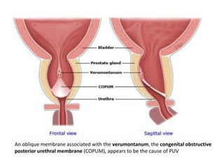 .
• .
An oblique membrane associated with the verumontanum, the congenital obstructive
posterior urethral membrane (COPUM), appears to be the cause of PUV
 