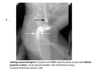 .
• .
Voiding cystourethrogram of patient with PUV noted by white arrows with dilated
posterior urethra. Small capacity bladder with VUR (black arrows).
Courtesy of Nicholas Holmes, MD.
 