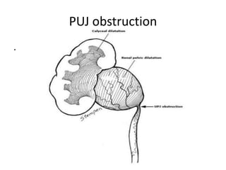 PUJ obstruction
.
 