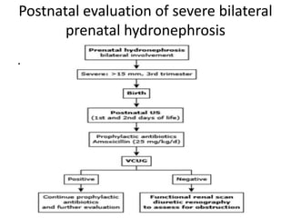 Postnatal evaluation of severe bilateral
prenatal hydronephrosis
.
 