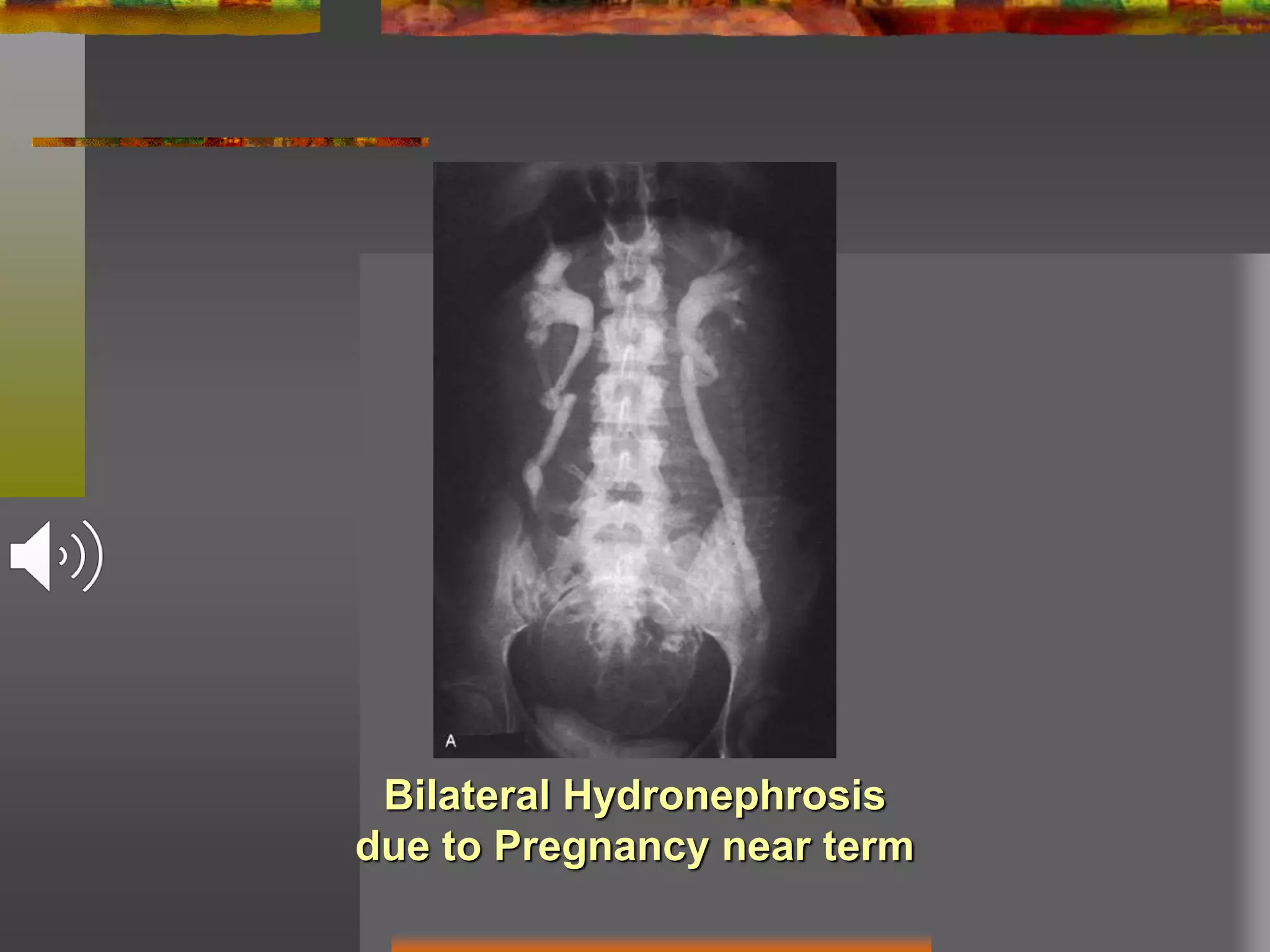 Bilateral Hydronephrosis
due to Pregnancy near term
 