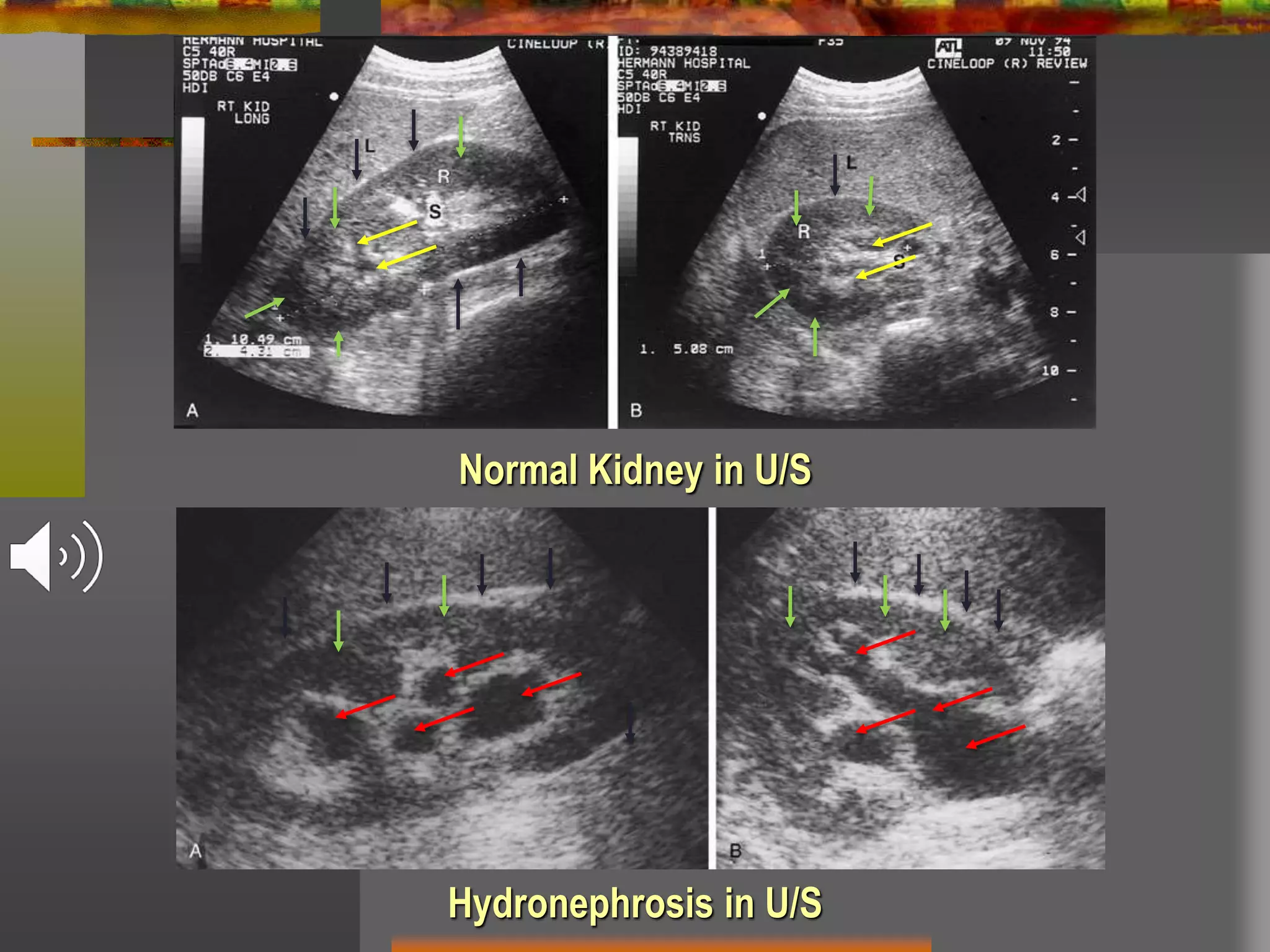 Hydronephrosis in U/S
Normal Kidney in U/S
 