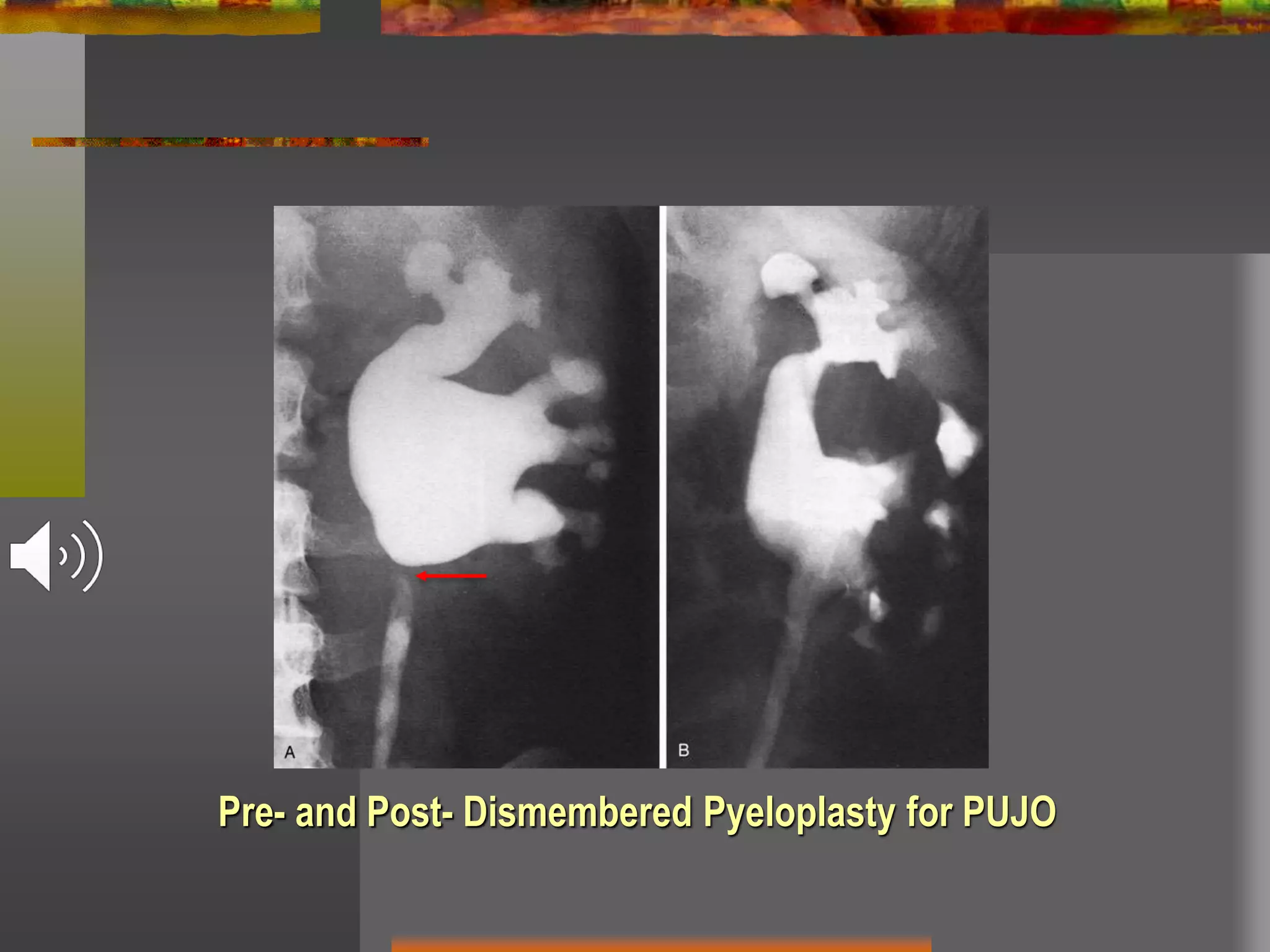 Pre- and Post- Dismembered Pyeloplasty for PUJO
 