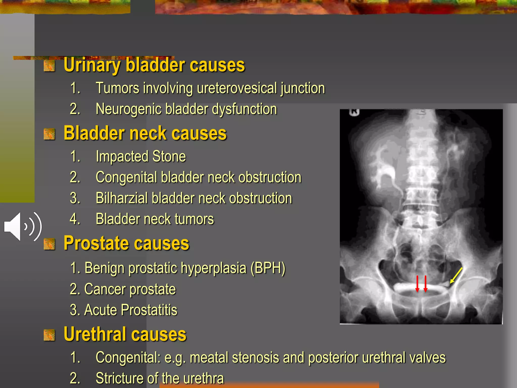 Urinary bladder causes
1. Tumors involving ureterovesical junction
2. Neurogenic bladder dysfunction
Bladder neck causes
1. Impacted Stone
2. Congenital bladder neck obstruction
3. Bilharzial bladder neck obstruction
4. Bladder neck tumors
Prostate causes
1. Benign prostatic hyperplasia (BPH)
2. Cancer prostate
3. Acute Prostatitis
Urethral causes
1. Congenital: e.g. meatal stenosis and posterior urethral valves
2. Stricture of the urethra
 
