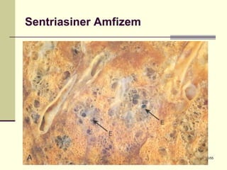 Sentriasiner Amfizem




Dr. Olgun Kontaş * Obstrüktif Akciğer Hastalıkları   16/55
 