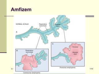 Amfizem




Dr. Olgun Kontaş * Obstrüktif Akciğer Hastalıkları   17/55
 