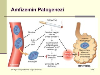 Amfizemin Patogenezi




Dr. Olgun Kontaş * Obstrüktif Akciğer Hastalıkları   23/55
 