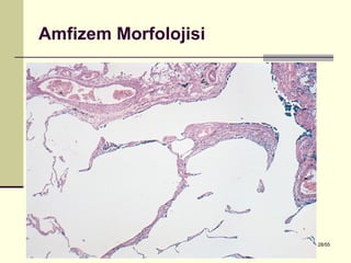 Amfizem Morfolojisi




Dr. Olgun Kontaş * Obstrüktif Akciğer Hastalıkları   28/55
 