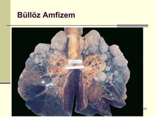 Büllöz Amfizem




Dr. Olgun Kontaş * Obstrüktif Akciğer Hastalıkları   31/55
 