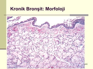 Kronik Bronşit: Morfoloji




Dr. Olgun Kontaş * Obstrüktif Akciğer Hastalıkları   36/55
 