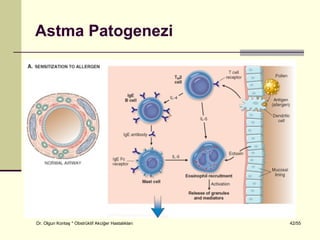 Astma Patogenezi




Dr. Olgun Kontaş * Obstrüktif Akciğer Hastalıkları   42/55
 