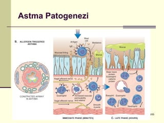 Astma Patogenezi




Dr. Olgun Kontaş * Obstrüktif Akciğer Hastalıkları   43/55
 