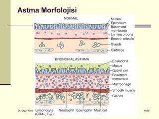 Astma Morfolojisi




Dr. Olgun Kontaş * Obstrüktif Akciğer Hastalıkları   48/55
 