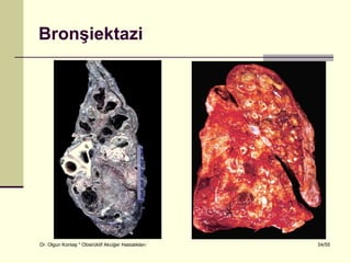 Bronşiektazi




Dr. Olgun Kontaş * Obstrüktif Akciğer Hastalıkları   54/55
 