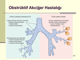 Obstrüktif Akciğer Hastalığı




Dr. Olgun Kontaş * Obstrüktif Akciğer Hastalıkları   9/55
 