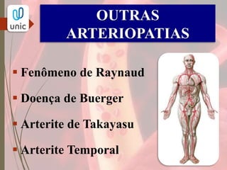 OUTRAS
ARTERIOPATIAS
FENÔMENO DE RAYNAUD
TRÍADE  Palidez intensa seguida de Cianose e Hiperemia reacional.
 Episódios recorrentes de vasoespasmo digital,
desencadeados pelo frio ou estresse emocional.
 Pode levar à ulceração e perda digital.
 Associado a doenças hematológicas, reumatológicas.
 
