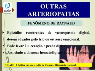 OUTRAS
ARTERIOPATIAS
DOENÇA DE BUERGER
Quando suspeitar?  Jovens tabagistas sem outros fatores de risco para aterosclerose.
 Exclusivamente associada ao tabagismo.
 Mais comum nas artérias musculares (vasos tibiais).
 Quadro típico  Dor em repouso, gangrena e
ulceração.
 “Flebite migratória” é característica.
 