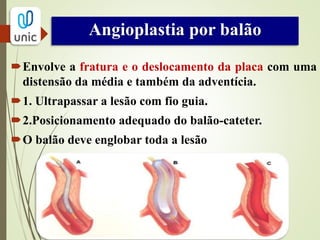 Angioplastia por stent
 