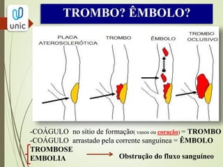 O que é um êmbolo?
- É um coágulo originado de outro local da circulação,
geralmente coração, liberado para a circulação e
obstruindo um ramo arterial de qualquer local do corpo.
Os membros inferiores são os locais mais atingidos.
De onde originam os êmbolos?
- 80% dos êmbolos arteriais são de origem cardíaca. Sendo
a FA a causa mais comum dos êmbolos cardiogênicos e o
IAM a segunda mais comum.
EMBOLIAARTERIAL
 