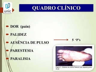  DIAGNÓSTICO CLÍNICO
- Anamnese + exame físico
EMBÓLICO?
Fatores de risco (FA, IAM prévio, prótese cardíaca), início
súbito dos sintomas, sem claudicação prévia, achados
unilaterais.
TROMBÓTICO?
Fatores de risco (placas ateroscleróticas no vaso), tem
sintomas de claudicação prévia , achados bilaterais.
DIAGNÓSTICO
 