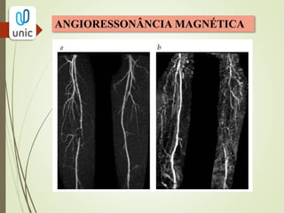 TRATAMENTO
OCLUSÃO EMBÓLICA
- Anticoagulação com bolus de heparina IV (5.000 a
10.000 unidades);
- Revascularização rápida para restauração do fluxo;
- Embolectomia com balão:
introdução de um cateter adaptado ao calibre do vaso e é introduzido
pela arteriotomia, após atravessar o trombo, o balonete é inflado e retirado
carregando consigo o êmbolo.
 