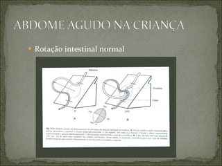 Rotação intestinal normal 