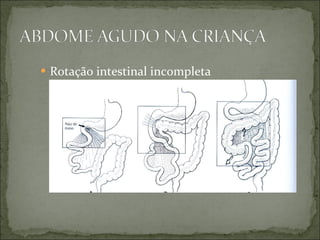 Rotação intestinal incompleta 