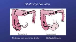 Obstrução doColon
ObstruçãoSimples
Obstrução com sofrimento de alça
 