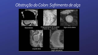 Obstrução doColon:Sofrimento de alça
 